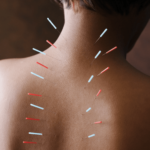Acupuncture taught me that my shoulders are connected to my gut