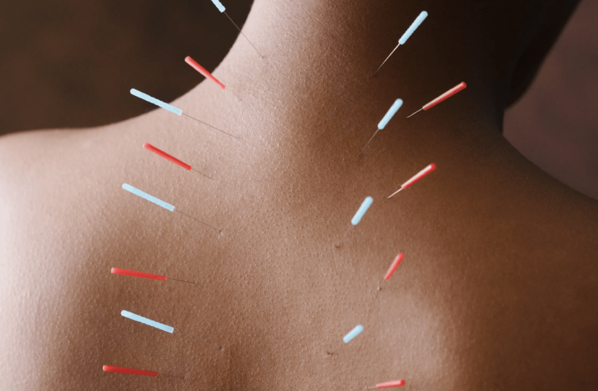 Acupuncture taught me that my&hellip;