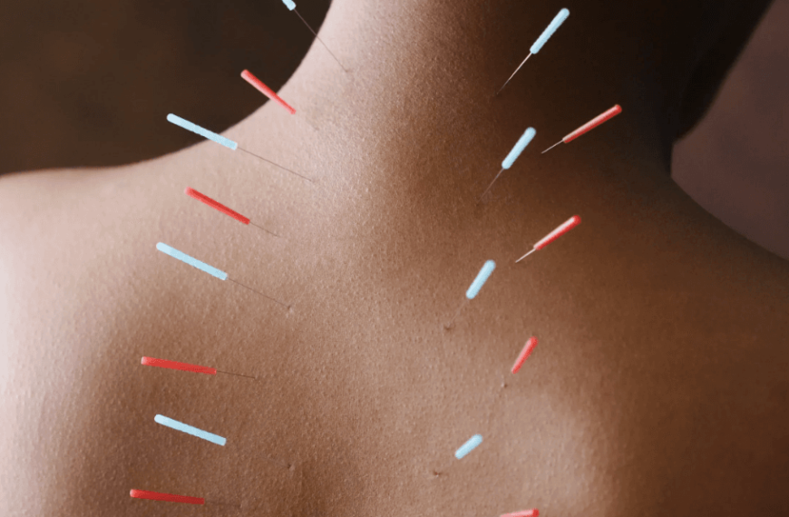 I struggled to move on from a heartbreak — until I tried acupuncture for emotional healing